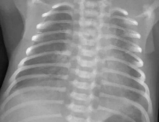 儿科CPAP为什么镇静【医疗技术】龙湖区医共体集团总院儿科应用鼻塞式CPAP治疗早期新生儿肺透明膜病_https://www.jmylbn.com_新闻资讯_第3张