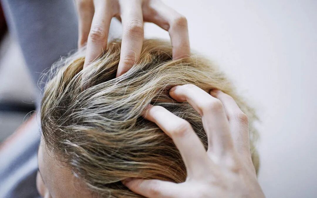 分清头皮炎症 才能对症治疗