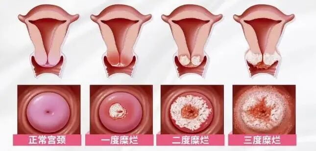 蓝光妇科治疗是什么红蓝光科普系列丨必须要知道的女性健康“拦路虎”！红蓝光来帮忙！_https://www.jmylbn.com_新闻资讯_第7张