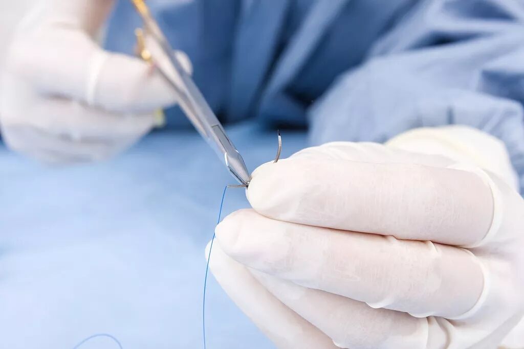 缝线怎么吸收【医疗知识】外科缝线知多少？这篇文章讲全了！_https://www.jmylbn.com_新闻资讯_第4张