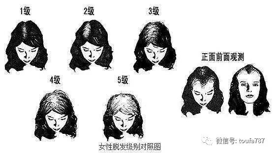 女性脱发的原因和解决办法