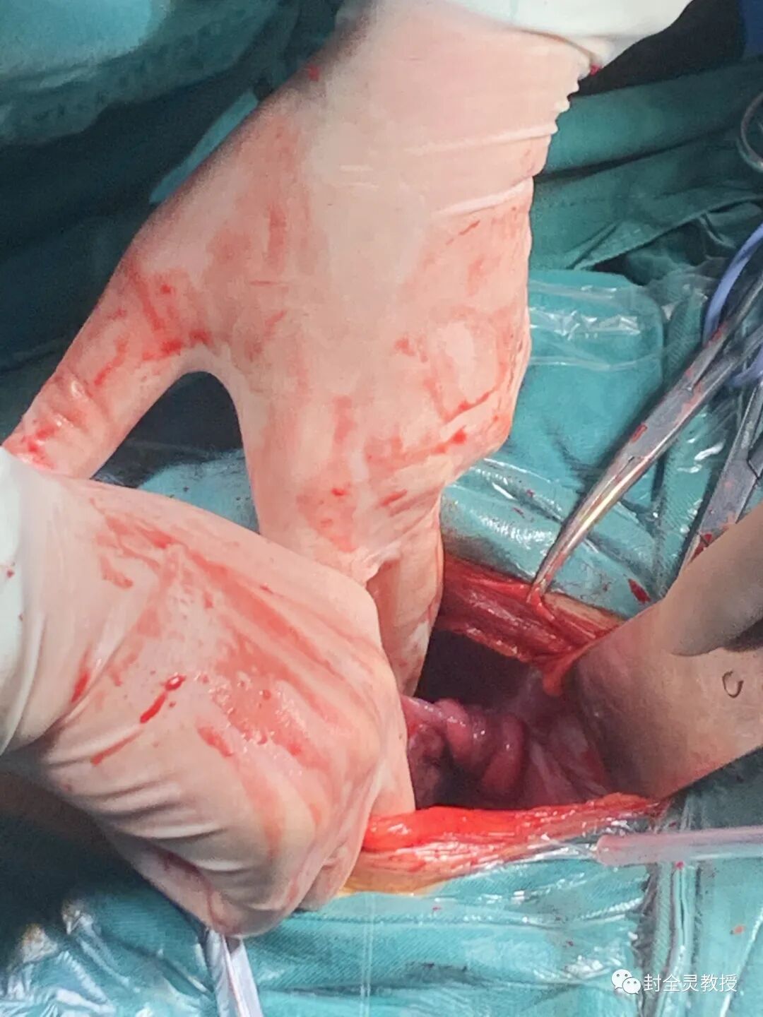 卵巢畸胎瘤1cm_卵巢畸胎瘤中期可以治愈率_卵巢畸胎瘤100个人中有几个