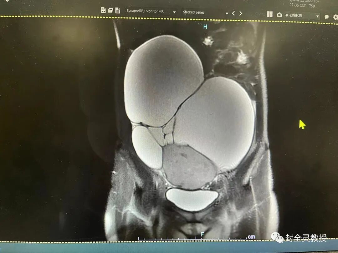 卵巢畸胎瘤中期可以治愈率_卵巢畸胎瘤100个人中有几个_卵巢畸胎瘤1cm