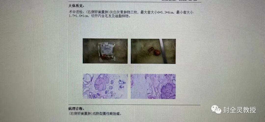 卵巢畸胎瘤100个人中有几个_卵巢畸胎瘤中期可以治愈率_卵巢畸胎瘤1cm