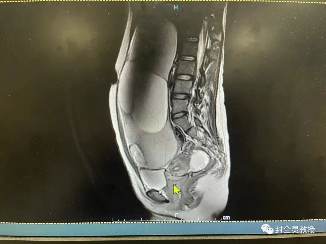 卵巢畸胎瘤100个人中有几个_卵巢畸胎瘤1cm_卵巢畸胎瘤中期可以治愈率