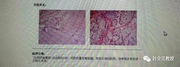 卵巢畸胎瘤1cm_卵巢畸胎瘤100个人中有几个_卵巢畸胎瘤中期可以治愈率