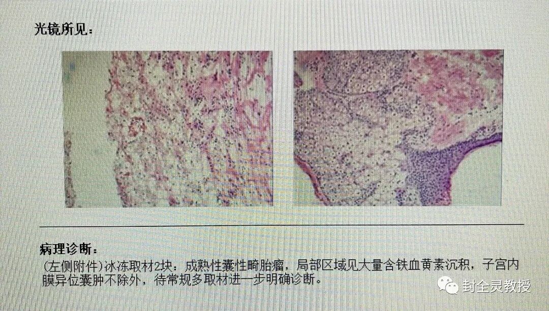 卵巢畸胎瘤100个人中有几个_卵巢畸胎瘤中期可以治愈率_卵巢畸胎瘤1cm