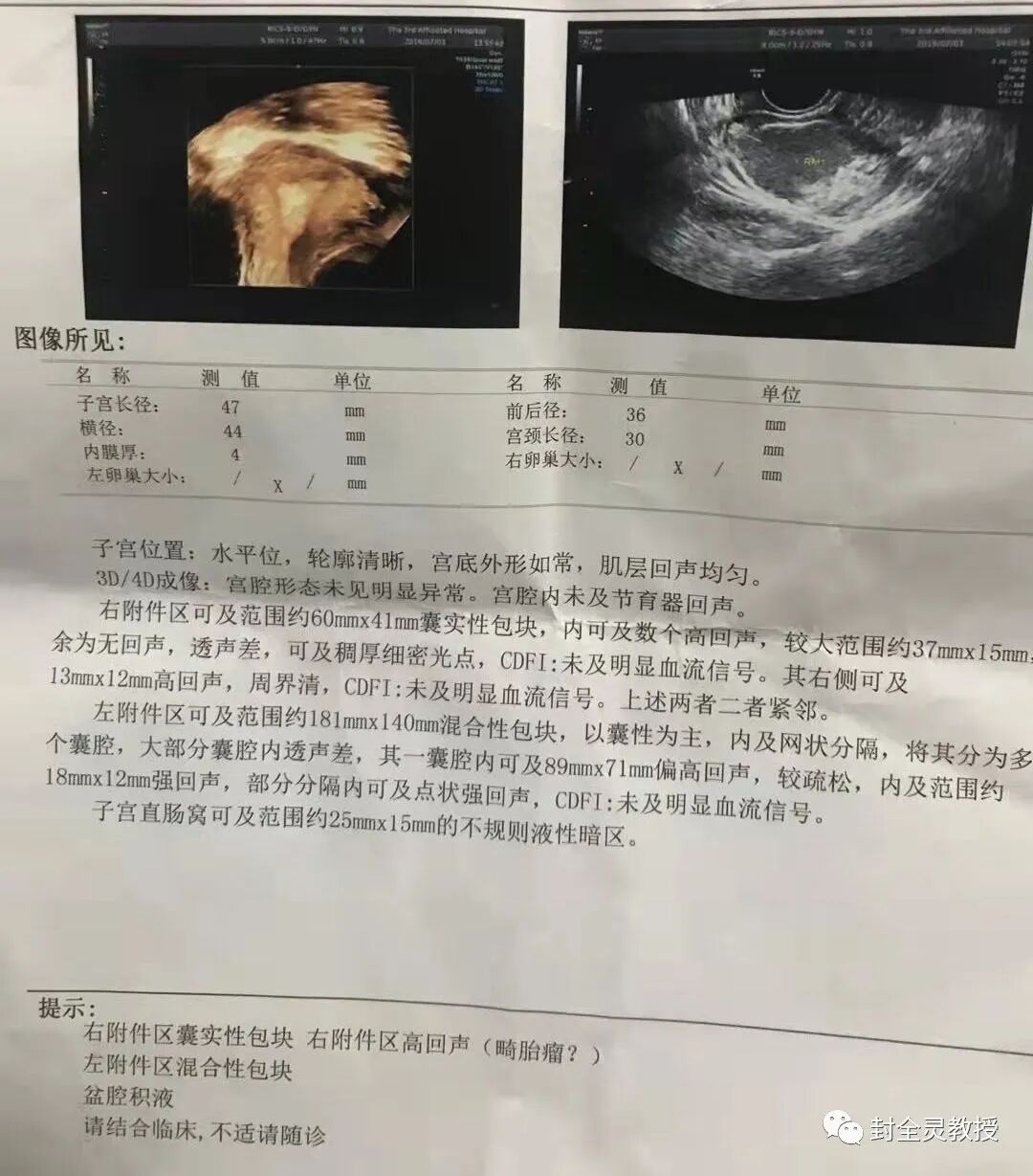 卵巢畸胎瘤1cm_卵巢畸胎瘤100个人中有几个_卵巢畸胎瘤中期可以治愈率