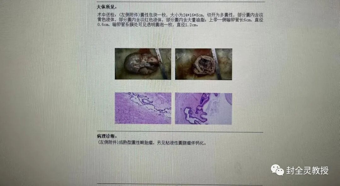 卵巢畸胎瘤1cm_卵巢畸胎瘤中期可以治愈率_卵巢畸胎瘤100个人中有几个