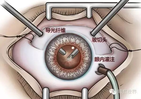 肇庆爱尔眼科医院成功实施首例玻璃体切割手术顺利完成