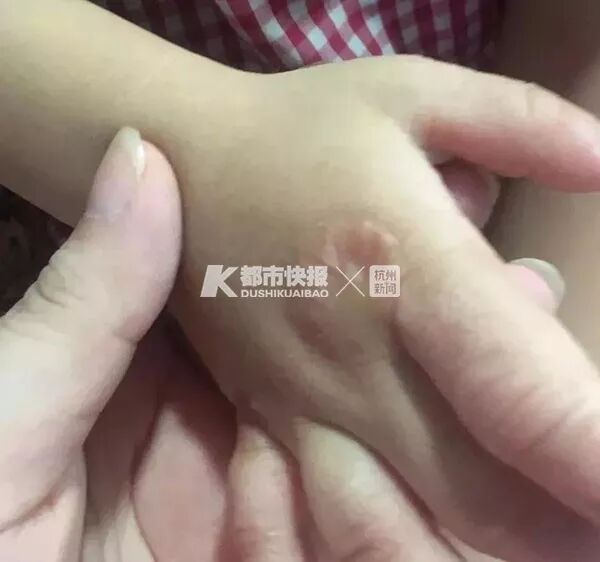 3岁男孩啃掉自己手指，竟不哭不闹！这病无药可医…（组图） - 3