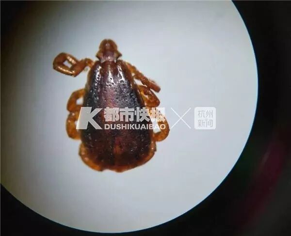 中国大叔被小虫子咬了口，高烧一周不退险些丧命！医生：这种病毒有人传人的风险（组图） - 5