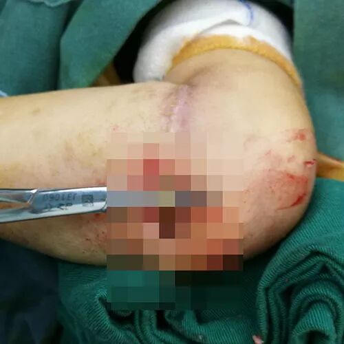 4岁女童得怪病，手臂长一圈肉环，手术取出一根东西谁都没想到... - 3