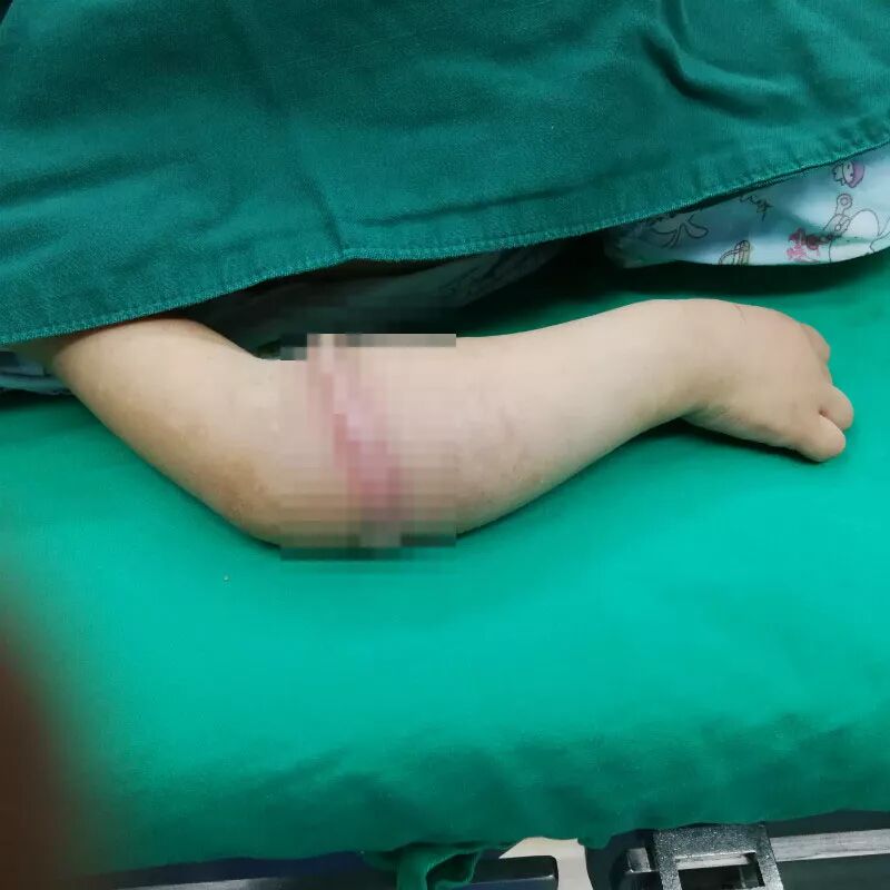 4岁女童得怪病，手臂长一圈肉环，手术取出一根东西谁都没想到... - 1