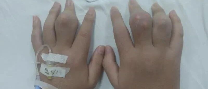 至少两天一杯奶茶，18岁小伙喝出痛风，手脚关节畸形可怕！杭州也有00后“中招”