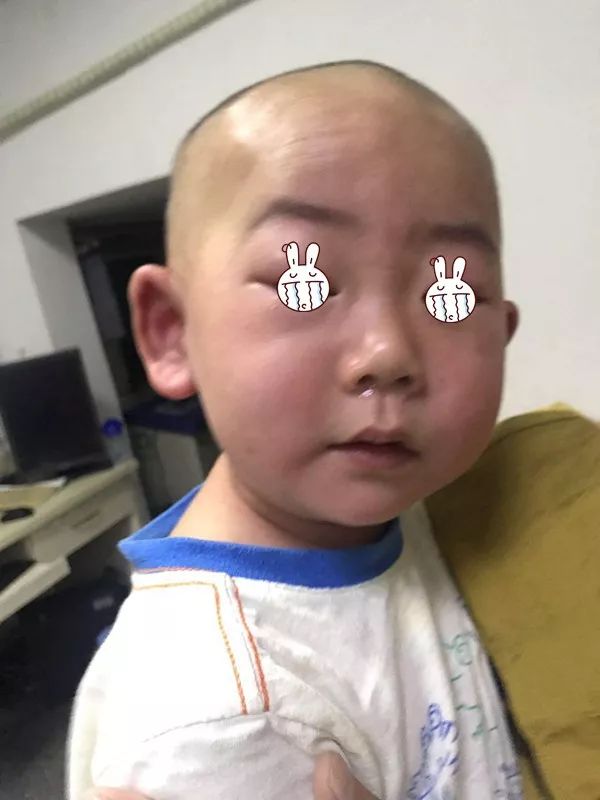 19個月寶寶8次過敏，每次都是吃了面條或餅乾！醫生提醒：千萬別僥幸！ 親子 第5張