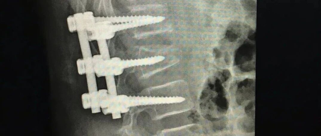 浙江11岁女孩玩蹦床摔成爆裂性骨折，腰椎打了3根钉子！类似事故已发生多起