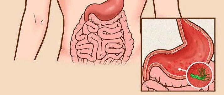 美国将幽门螺杆菌列为致癌物，我国感染率超50%，有人因发展成胃癌切了大半个胃！这个细菌该怎么防？