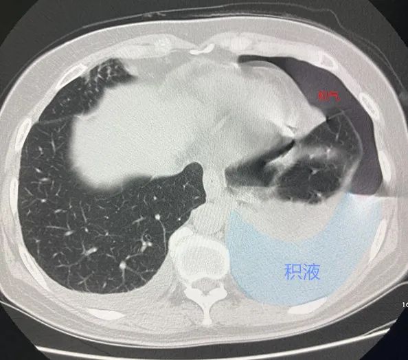 朋友說生吃螃蟹能強壯骨骼，40多歲阿姨一口氣生吃30多隻，結果寄生蟲在她身體裡安了家…… 健康 第2張