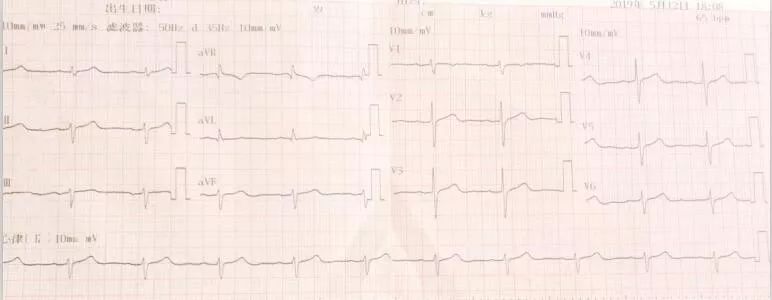專欄丨賈衛濱：呼吸困難，心力衰竭抑或呼吸衰竭？心電圖來辨別（2）——單純呼吸衰竭 健康 第7張