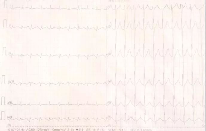 專欄丨賈衛濱：呼吸困難，心力衰竭抑或呼吸衰竭？心電圖來辨別（2）——單純呼吸衰竭 健康 第9張