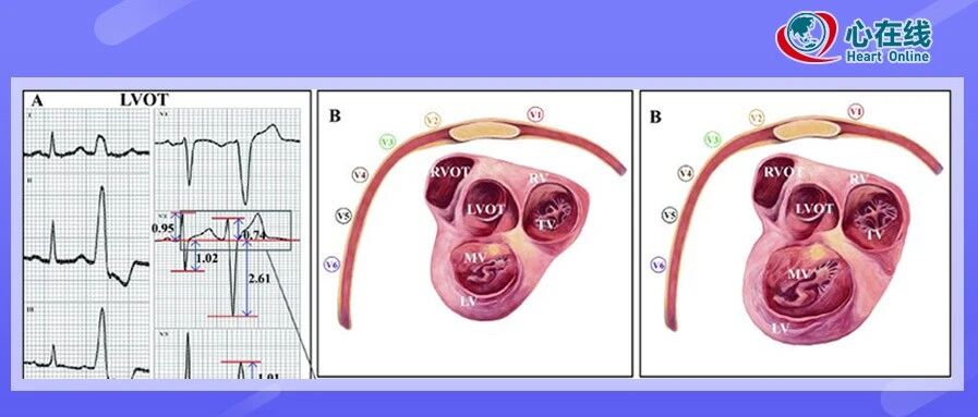 进展丨方丕华团队提出鉴别左右室流出道室性心律失常的新标准