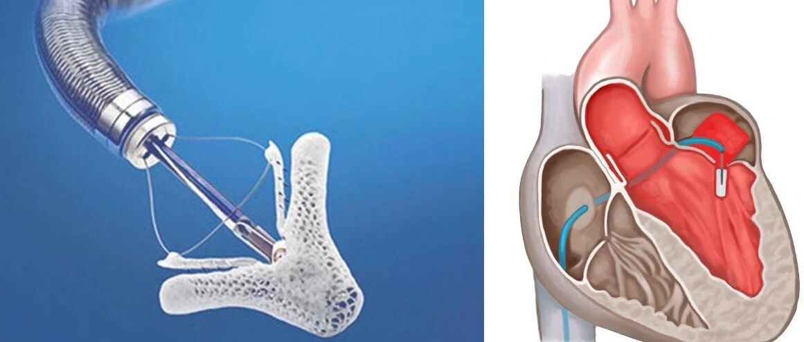 病例丨MitraClip相关感染性心内膜炎