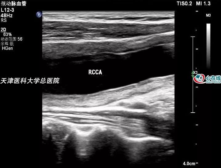 心電在線丨年輕女性胸悶、心慌，超聲檢查有大發現 健康 第15張