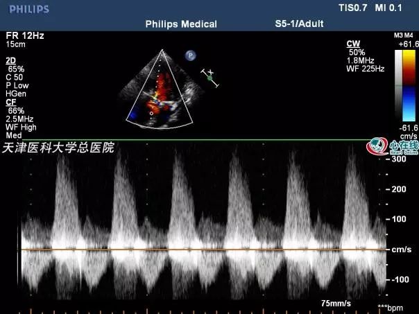 心電在線丨年輕女性胸悶、心慌，超聲檢查有大發現 健康 第9張