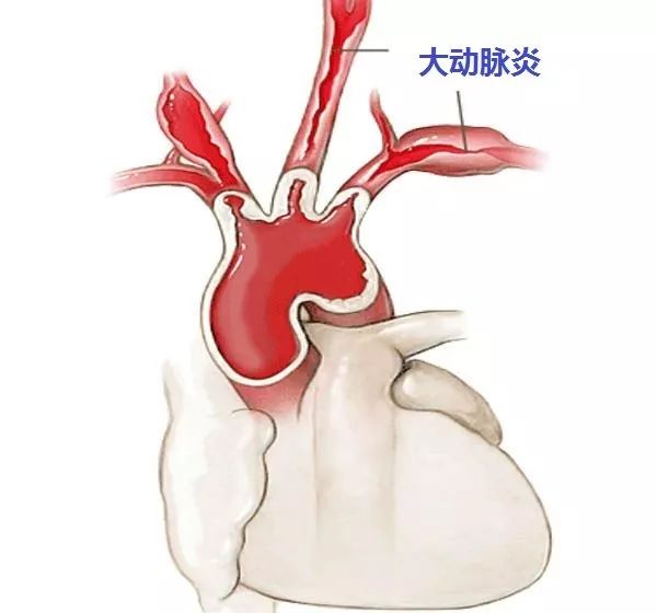 心電在線丨年輕女性胸悶、心慌，超聲檢查有大發現 健康 第18張