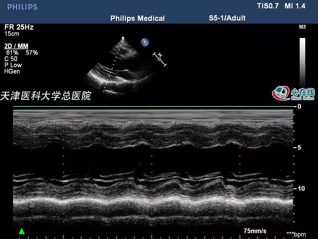 心電在線丨年輕女性胸悶、心慌，超聲檢查有大發現 健康 第5張