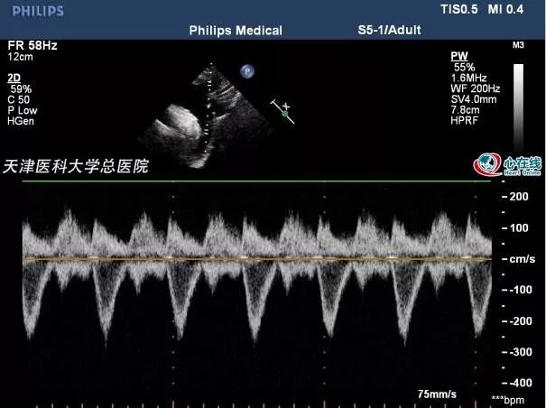 心電在線丨年輕女性胸悶、心慌，超聲檢查有大發現 健康 第12張