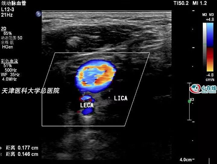 心電在線丨年輕女性胸悶、心慌，超聲檢查有大發現 健康 第14張