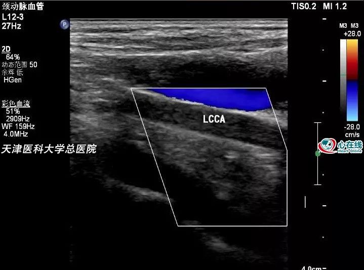 心電在線丨年輕女性胸悶、心慌，超聲檢查有大發現 健康 第13張