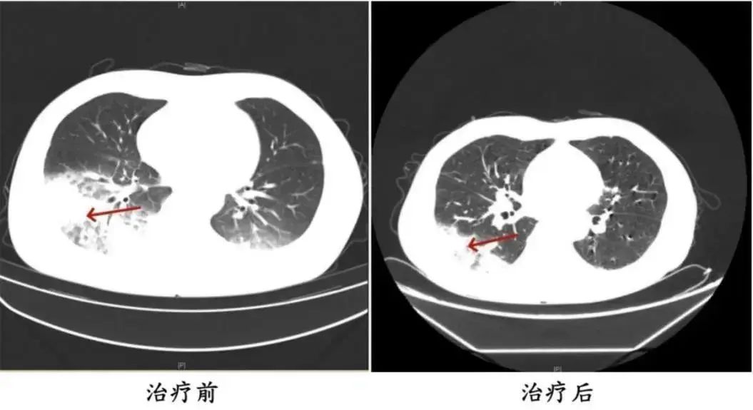 男子连吹3天空调，肺“白”了一半,吹了3天空调，一男子突然查出“白肺”！严重可致休..