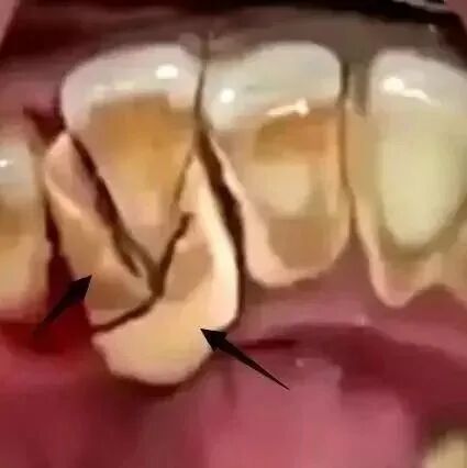 知道么！牙结石就是口腔中的大恶魔！