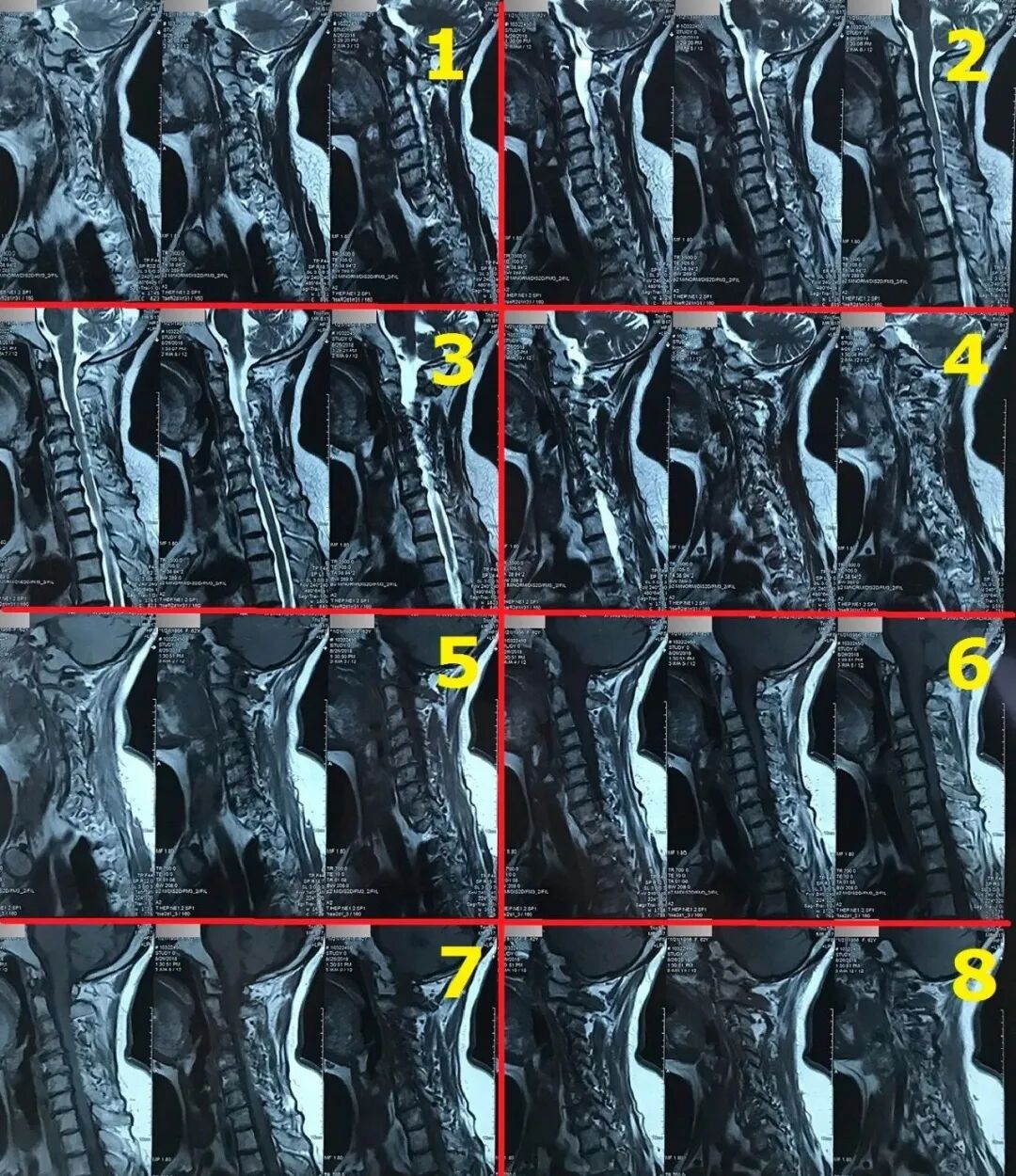 ct打印胶片怎么用远程就医、转院就医时，CT核磁DICOM电子胶片的重要性！【就医知识】_https://www.jmylbn.com_新闻资讯_第9张