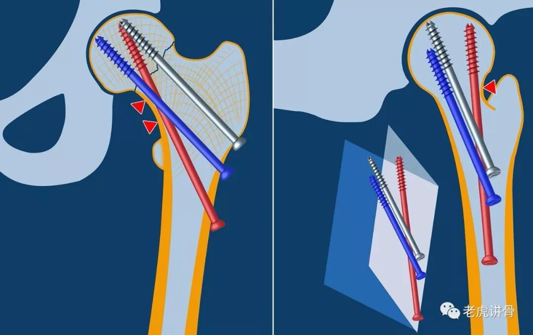 股骨颈骨折:双平面双支撑螺钉固定技术_医学界-助力医生临床决策和
