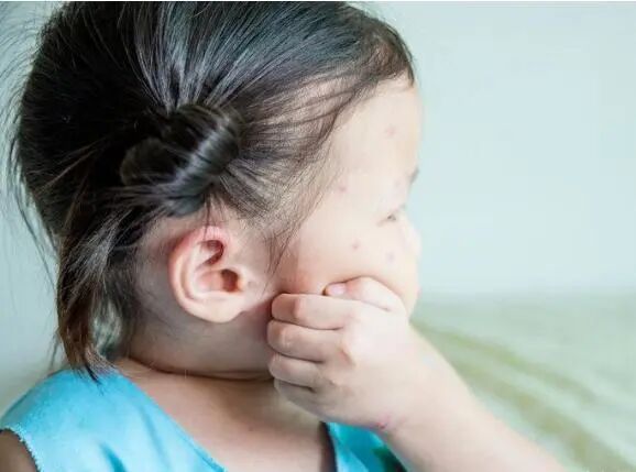 怎么判断是螨虫咬的包 24岁女孩眼睛长58条螨虫致眼角膜损伤，几乎失明！医生教你如何辨别感染螨虫