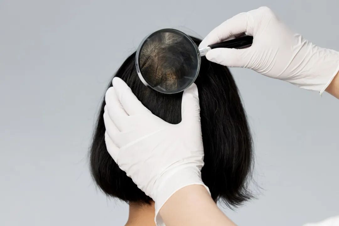 总是掉头发，是身体出问题了吗？