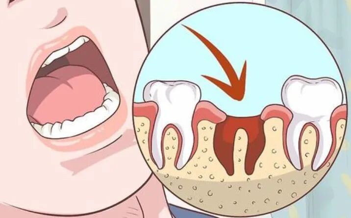 止血海绵是什么一块海绵几十元？说说拔牙窝里塞的明胶海绵_https://www.jmylbn.com_新闻资讯_第12张