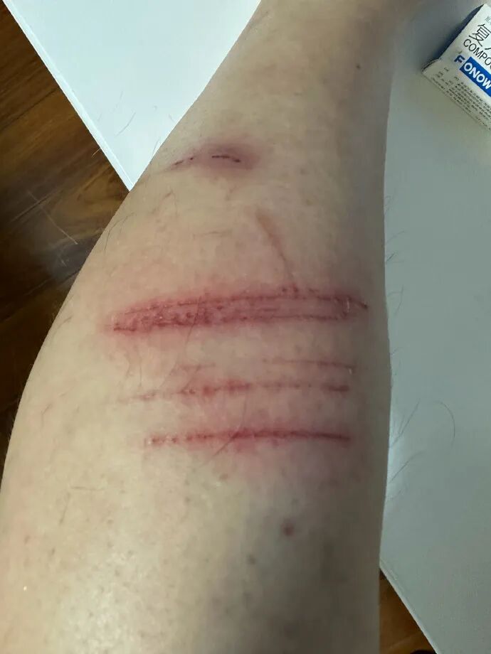 医用凡士林敷料怎么用6岁女童在小区摸了下竹子，手掌被扎了200根刺！孩子的妈妈用各种“偏方”拔刺：醋泡、用瓶子吸、针挑、胶布粘……手掌差点报废_https://www.jmylbn.com_新闻资讯_第9张