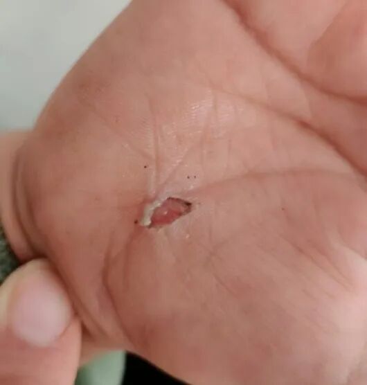 医用凡士林敷料怎么用6岁女童在小区摸了下竹子，手掌被扎了200根刺！孩子的妈妈用各种“偏方”拔刺：醋泡、用瓶子吸、针挑、胶布粘……手掌差点报废_https://www.jmylbn.com_新闻资讯_第56张