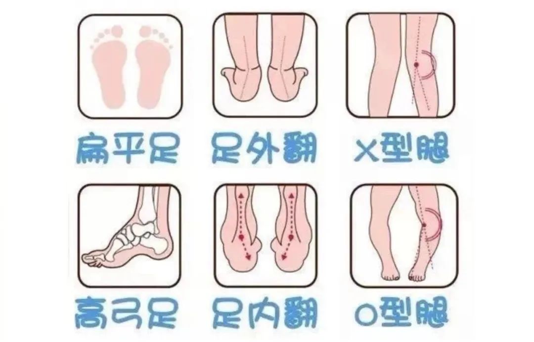 孩子八字脚走路，造成o型腿/x型腿，该如何进行矫正？