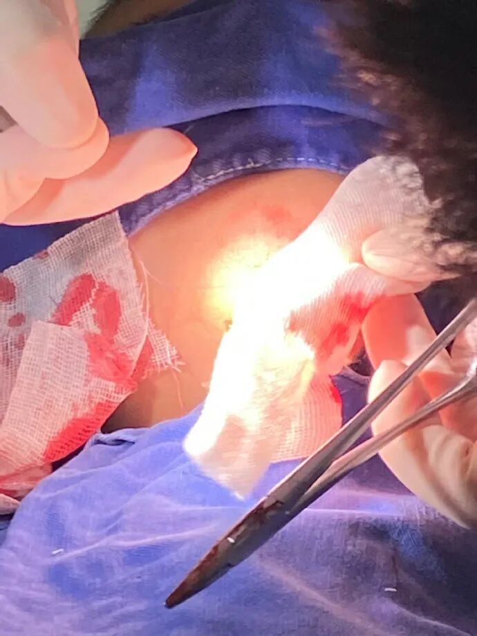 医用凡士林敷料怎么用6岁女童在小区摸了下竹子，手掌被扎了200根刺！孩子的妈妈用各种“偏方”拔刺：醋泡、用瓶子吸、针挑、胶布粘……手掌差点报废_https://www.jmylbn.com_新闻资讯_第28张