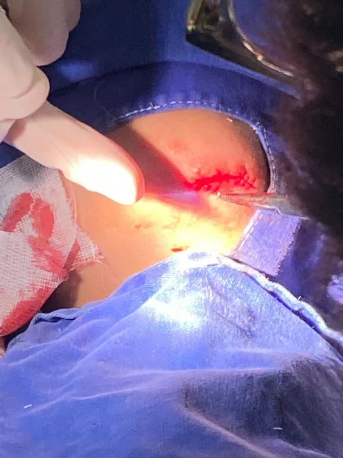 医用凡士林敷料怎么用6岁女童在小区摸了下竹子，手掌被扎了200根刺！孩子的妈妈用各种“偏方”拔刺：醋泡、用瓶子吸、针挑、胶布粘……手掌差点报废_https://www.jmylbn.com_新闻资讯_第29张