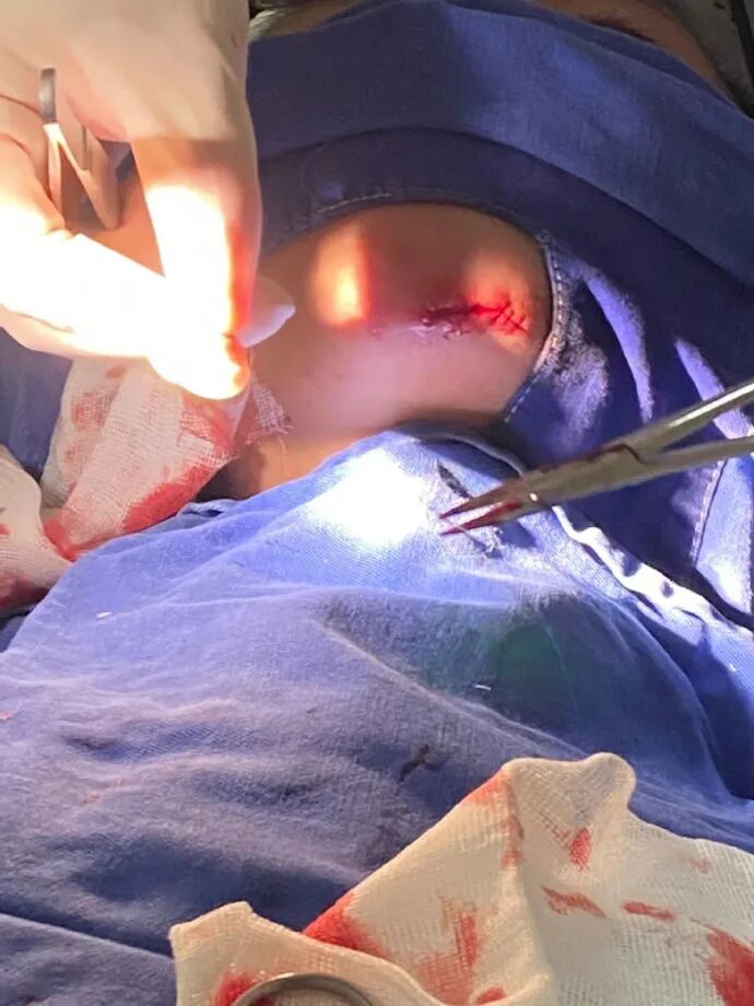 医用凡士林敷料怎么用6岁女童在小区摸了下竹子，手掌被扎了200根刺！孩子的妈妈用各种“偏方”拔刺：醋泡、用瓶子吸、针挑、胶布粘……手掌差点报废_https://www.jmylbn.com_新闻资讯_第33张