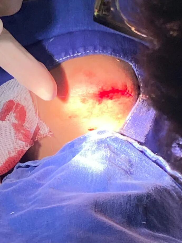 医用凡士林敷料怎么用6岁女童在小区摸了下竹子，手掌被扎了200根刺！孩子的妈妈用各种“偏方”拔刺：醋泡、用瓶子吸、针挑、胶布粘……手掌差点报废_https://www.jmylbn.com_新闻资讯_第30张