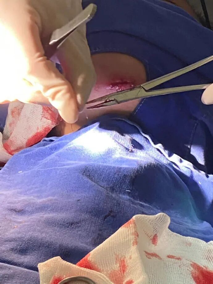 医用凡士林敷料怎么用6岁女童在小区摸了下竹子，手掌被扎了200根刺！孩子的妈妈用各种“偏方”拔刺：醋泡、用瓶子吸、针挑、胶布粘……手掌差点报废_https://www.jmylbn.com_新闻资讯_第34张