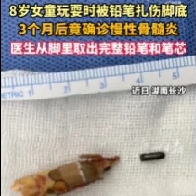 医用凡士林敷料怎么用6岁女童在小区摸了下竹子，手掌被扎了200根刺！孩子的妈妈用各种“偏方”拔刺：醋泡、用瓶子吸、针挑、胶布粘……手掌差点报废_https://www.jmylbn.com_新闻资讯_第93张